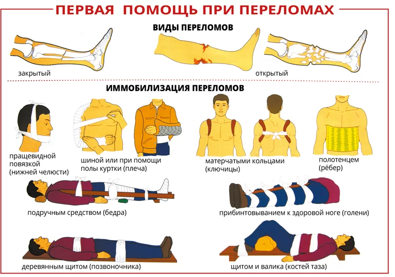 Как оказать первую помощь при переломах