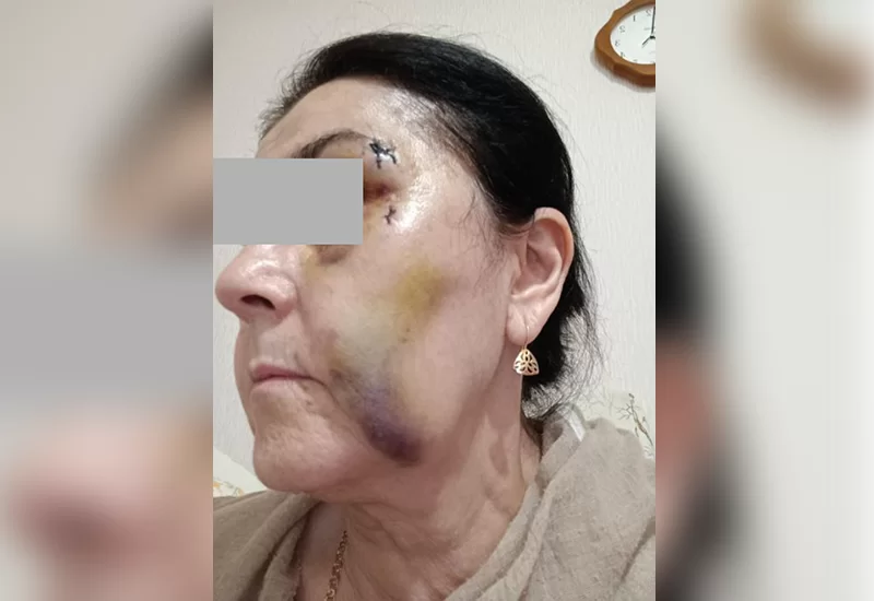 Попавшая под колеса велосипеда 60-летняя нижнекамка написала заявление в полицию